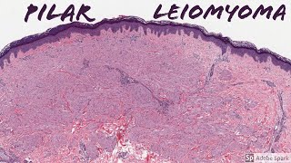 Leiomyoma Pilar Type Piloleiomyoma 5Minute Pathology Pearls [upl. by Ainotal]