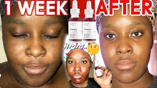 The Ordinary AHA 30 BHA 2 Peeling solution Before and After 1 week  How to Use amp How to Layer [upl. by Shamus]