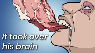 A Man Ate Undercooked Pork This Is What Doctors Found Inside His Brain [upl. by Debi330]