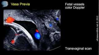 Left Ventricular Assist Device  LVAD Procedure [upl. by Cutty]