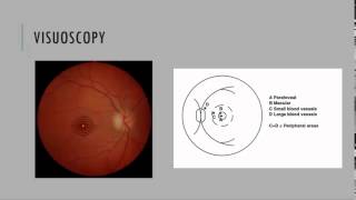 Visuoscopy Fixation Ophthalmoscopy [upl. by Gebhardt]