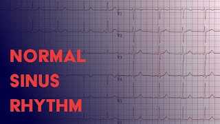 Normal Sinus Rhythm  EKG ECG Interpretation [upl. by Twum]