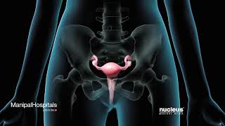 Method Used To Obtain Robotic Fibroids Tumor Removal  Robotic Myomectomy  Manipal Hospitals [upl. by Nosdivad]