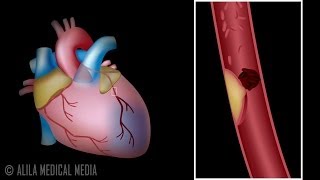 Coronary Angiogram of Myocardial Bridging [upl. by Licha589]