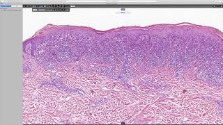 Lichenoid keratosis Phillip H McKee Antonina Kalmykova amp CSD Health Care [upl. by Clarissa]