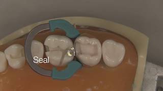 Class II Composite Restoration  Stevenson Dental Solutions [upl. by Ayarahs550]