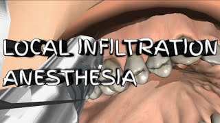 Local Infiltration AnesthesiaTechnique [upl. by Herschel93]