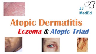 Eczema Atopic Dermatitis  Atopic Triad Triggers Who gets it Why does it happen amp Treatment [upl. by Gorga]