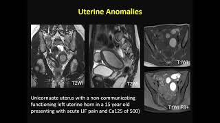 ISMRM MR Academy  Endometrial and Cervical Cancer [upl. by Noach]