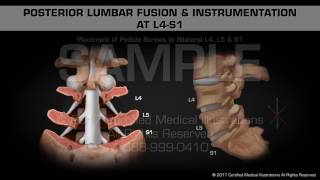 Posterior Lumbar Fusion amp Instrumentation at L4S1 [upl. by Mariandi]