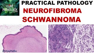 NEUROFIBROMA AND SCHWANNOMA Clinical features amp Morphology [upl. by Samala258]