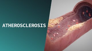 Atherosclerosis  Pathologies [upl. by Eimile161]