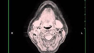 Glomus Tumor 5Minute Pathology Pearls [upl. by Saibot]