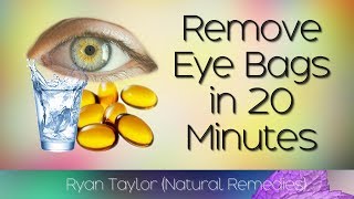 How To Remove Eye Bags 20 Minute Natural Remedies [upl. by Gelman395]