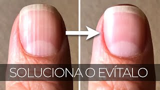 Cuidado ¿Por qué salen líneas en las uñas y cómo eliminarlas [upl. by Gavin]