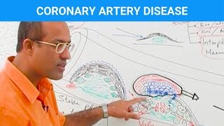 Coronary Artery Disease  Ischemic Heart Disease  Angina🫀 [upl. by Devondra]