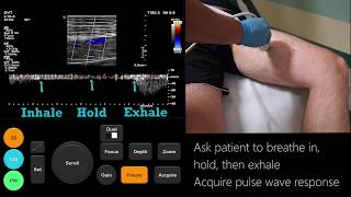 Ultrasound Tutorial DVT  Lower Limb Veins  Radiology Nation [upl. by Auqinal530]