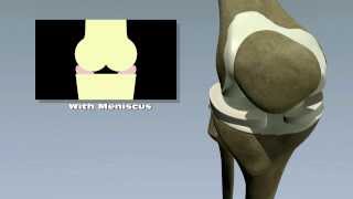 Meniscus Tears [upl. by Lrig]