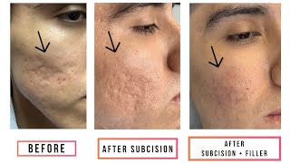 Subcision  Filler for Acne Scars [upl. by Refitsirhc]