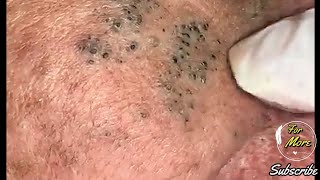 Dr Pop  Deep Blackheads in old Skin removing amp treatment 2020 Part 4 HD [upl. by Nawj]