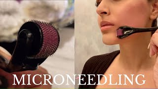 MICRONEEDLING AT HOME  How I Healed My Post Acne Scars Quickly [upl. by Eidolem460]