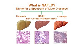 Will a Liver Cleanse Help Cirrhosis and a Fatty Liver – DrBerg [upl. by Eirek445]