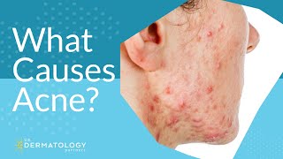 What Causes Acne  Explained by Dermatologist [upl. by Swetlana922]