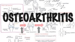 Osteoarthritis Overview causes pathophysiology investigations treatment [upl. by Guarino564]