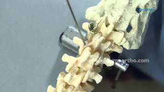 Pedicle Screw Fixation CORE Spinal System [upl. by Hjerpe]