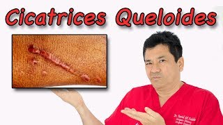 ¿Qué son las Cicatrices Queloides y cómo Tratarlas [upl. by Nodnab384]