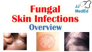 Overview of Fungal Skin Infections  Tinea Infections [upl. by Leinadnhoj]