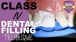 Class IV Composite Filling Tutorial  Front Tooth Filling [upl. by Gildea]