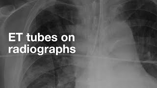 ET Tubes on Chest Xray [upl. by Atok387]