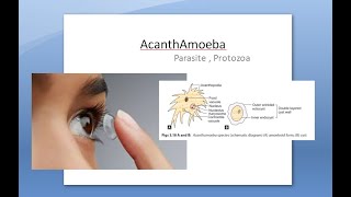 Ophthalmology 121 a AcanthAmoeba Keratitis Pseudo Dendrites eye cornea Contact lens PHMB [upl. by Eido]