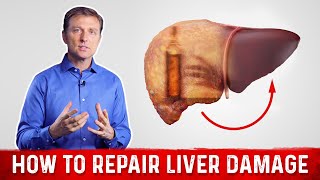 Best DIET FOR CIRRHOSIS of the Liver [upl. by Llertnad]