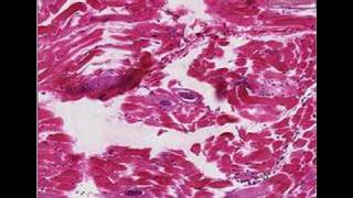 Histopathology Skeletal muscle Trichinosis [upl. by Yerxa]