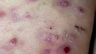 Cystic Acne Cysts Acne Dermatology Comedones and Whiteheads [upl. by Alimaj]