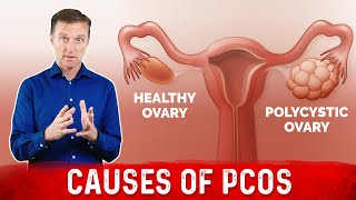 Natural way to treat Polycystic ovarian syndrome PCOSPCOD  Dr Vivek Joshi [upl. by Eniamret]