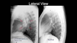 Chest Xray Cases 2 [upl. by Aletse]