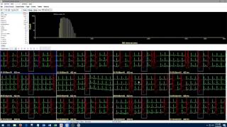 1 Introduction to Holter Analysis NEM [upl. by Eldwon]