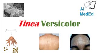 “Fungal Skin Infection of Many Colors” Tinea Versicolor  Pathogenesis Symptoms and Treatment [upl. by Aneral790]