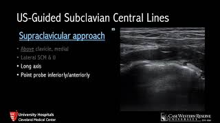 UltrasoundGuided Subclavian Lines [upl. by Ynohtn567]