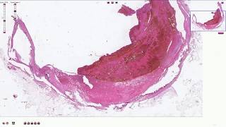 Atheromatous Plaque with Thrombosis  Histopathology [upl. by Elem942]