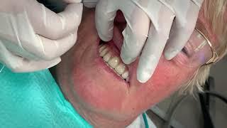 How flossing ALLON4 implants works [upl. by Prussian478]