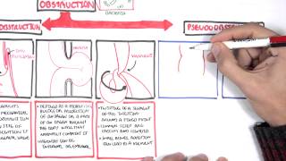 Bowel Obstruction  Causes and Pathophysiology [upl. by Thirzi976]