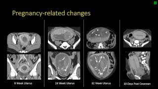 Gynecologic Radiology Anatomy [upl. by Kip]