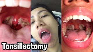 MY TONSILLECTOMY AND UVULECTOMY EXPERIENCE  Surgery amp Recovery BLOOD WARNING [upl. by Conlon]