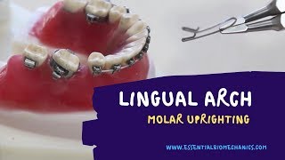 LingualArchforMolarUprighting [upl. by Annahsed]