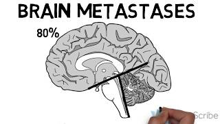 Brain Metastases [upl. by Heidie]