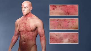 Atopic Dermatitis eczema From the Inside Out [upl. by Yendahc]